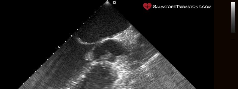 Infective Endocarditis